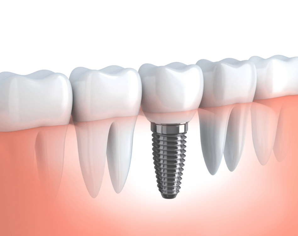 Dental Implants | Dawson Dental Centre | General & Family Dentist | Burnaby | BC