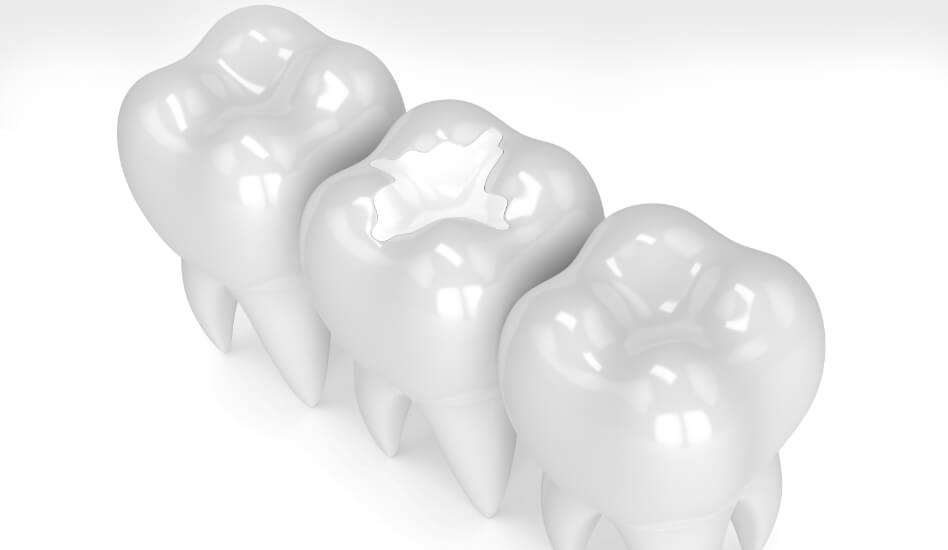 Tooth Coloured Fillings | Dawson Dental Centre | General & Family Dentist | Burnaby | BC