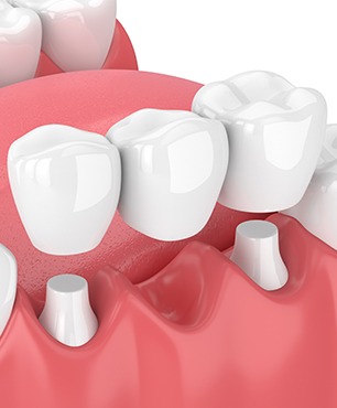 Dental Bridges | Dawson Dental Centre | General & Family Dentist | Burnaby | BC