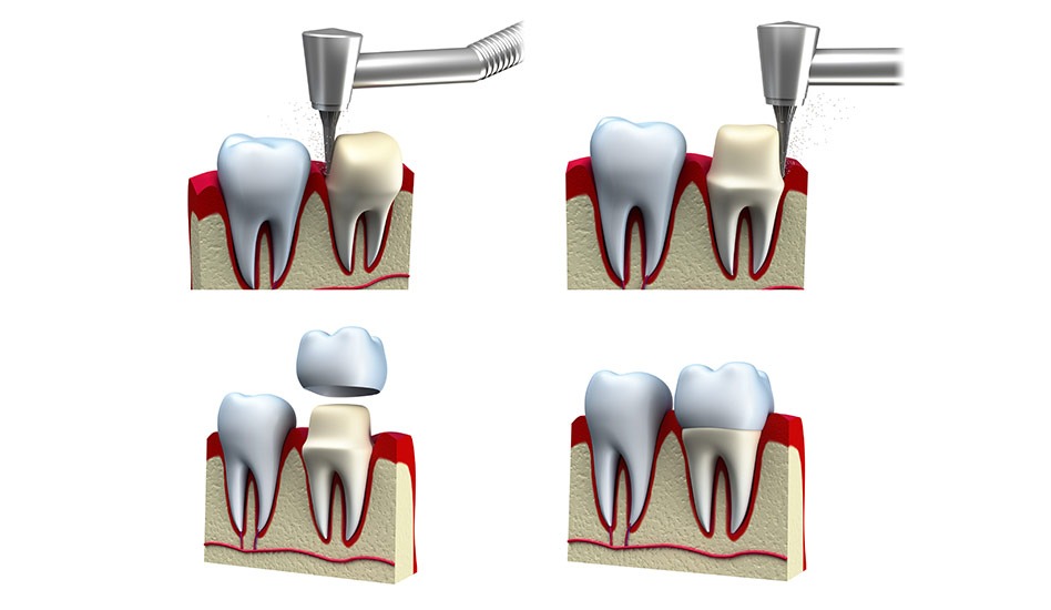 Dental Crowns | Dawson Dental Centre | General & Family Dentist | Burnaby | BC