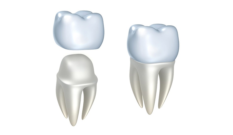 Dental Crowns | Dawson Dental Centre | General & Family Dentist | Burnaby | BC