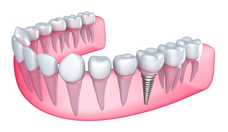 Dental Implant Crowns | Dawson Dental Centre | General & Family Dentist