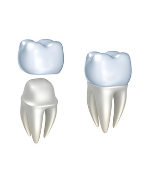 Dental Crowns | Dawson Dental Centre | General & Family Dentist | Burnaby | BC