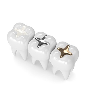 Dental Fillings | Dawson Dental Centre | General & Family Dentist | Burnaby | BC