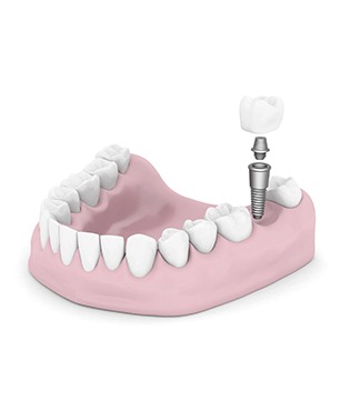 Dental Implant Crowns | Dawson Dental Centre | General & Family Dentist | Burnaby | BC