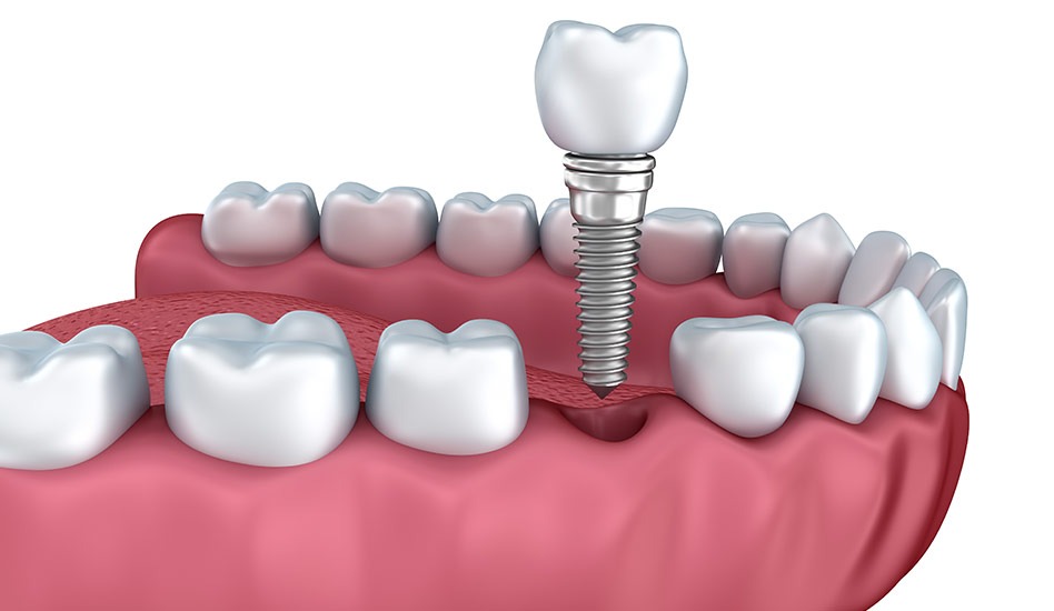 Dental Implant Surgery in Burnaby BC | Dawson Dental Centre