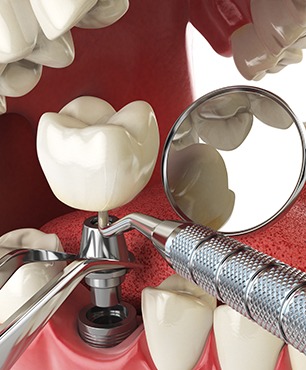 Dental Implant Surgery | Dawson Dental Centre | General & Family Dentist | Burnaby | BC