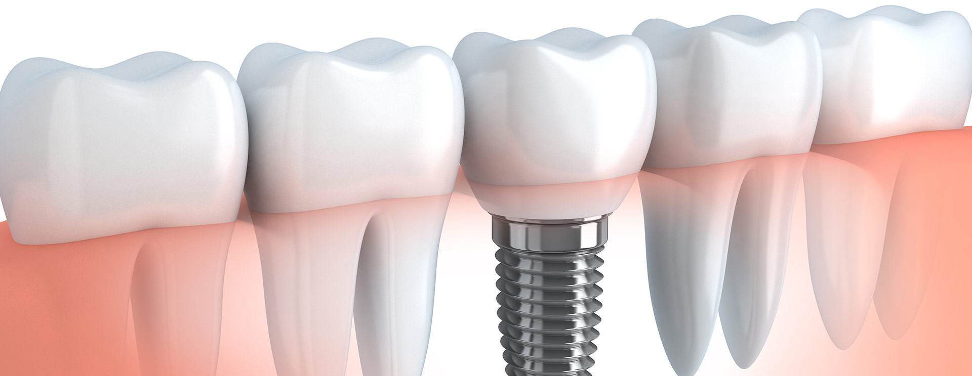 Dental Implants Burnaby | Dawson Dental Centre | General & Family Dentist