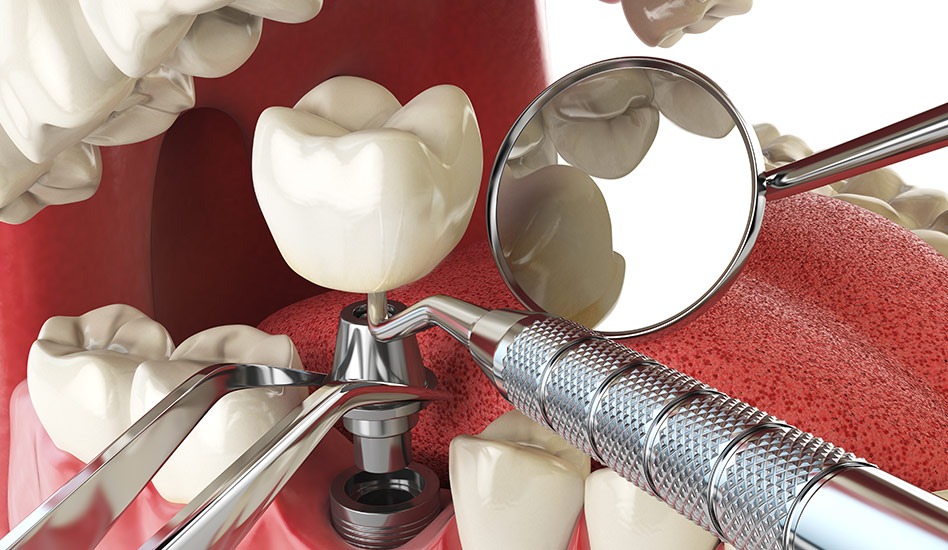 Oral Surgery | Dawson Dental Centre | General & Family Dentist | Burnaby | BC