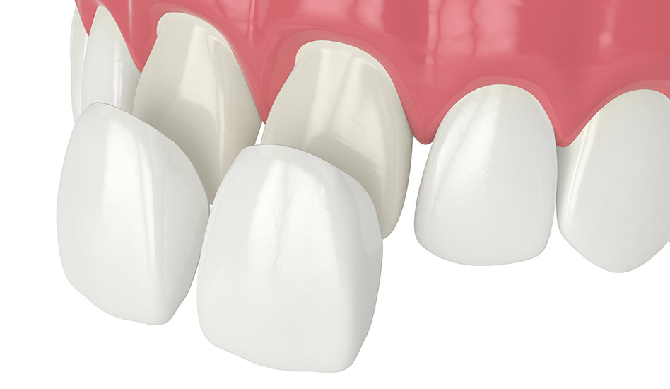 Porcelain Veneers | Dawson Dental Centre | General & Family Dentist | Burnaby | BC