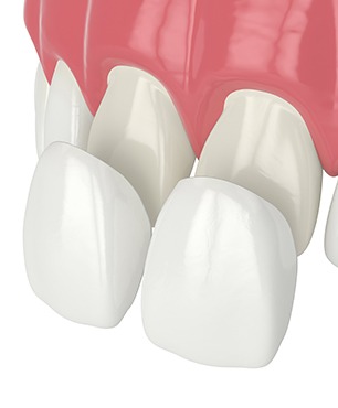 Porcelain Veneers | Dawson Dental Centre | General & Family Dentist | Burnaby | BC