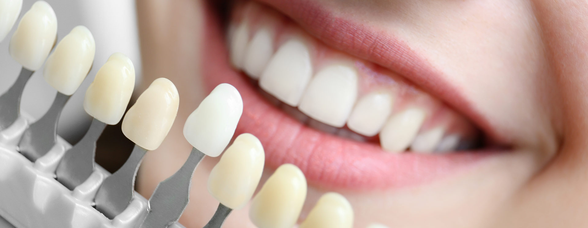 Porcelain Veneers | Dawson Dental Centre | General & Family Dentist | Burnaby | BC