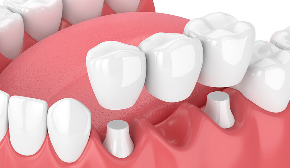 Restorative Dentistry | Dawson Dental Centre | General & Family Dentist | Burnaby | BC