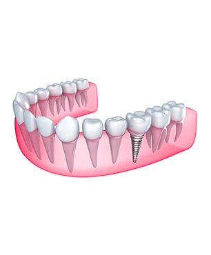 Restorative Dentistry | Dawson Dental Centre | General & Family Dentist | Burnaby | BC
