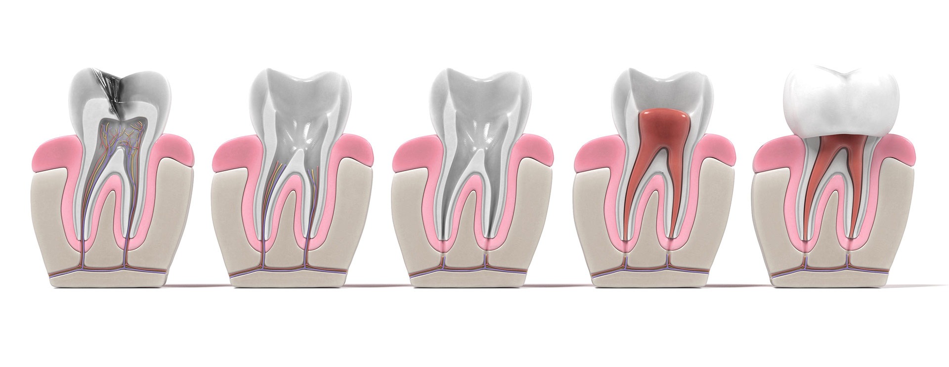 Root Canal Treatment Burnaby | Dawson Dental Centre | General & Family Dentist