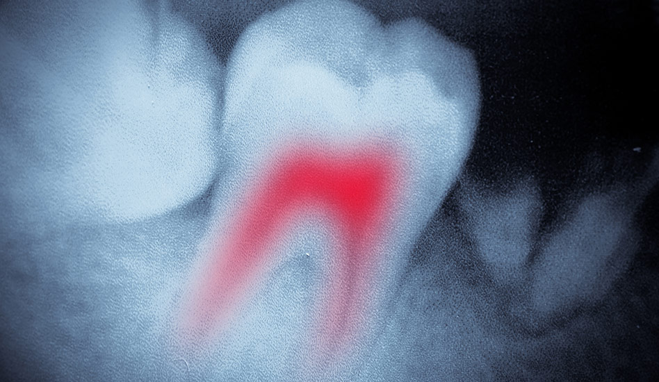 What is Root Canal Therapy? | Dawson Dental Centre | General & Family Dentist