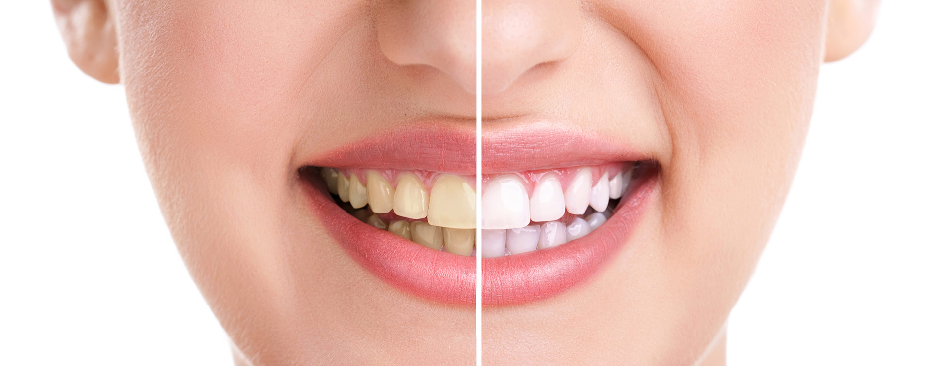 Teeth Whitening | Dawson Dental Centre | General & Family Dentist | Burnaby | BC