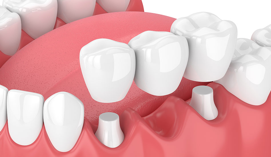 Dental Bridges | Dawson Dental Centre | General & Family Dentist | Burnaby | BC