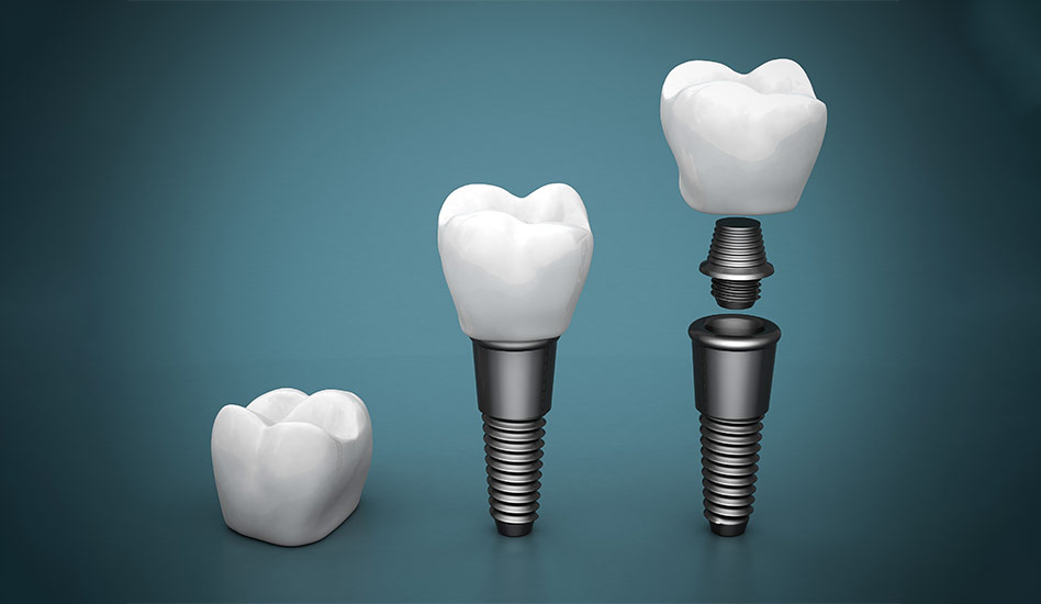 Dental Crowns | Dawson Dental Centre | General & Family Dentist | Burnaby | BC